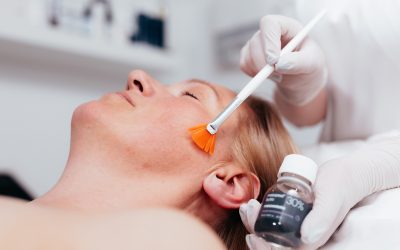 Kemijski piling za lice: zašto je i dalje jedan od najtraženijih tretmana za ljepšu i ujednačeniju kožu